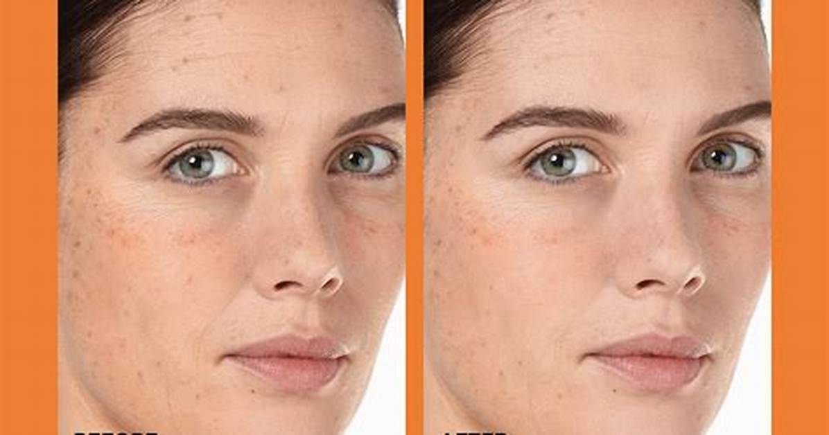 Before and After at the C Spot La: Dermatologist Insights and Treatment Results