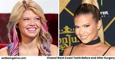 Chanel West Coast Teeth Before and After 2021: Visual Evidence and Procedure Breakdown
