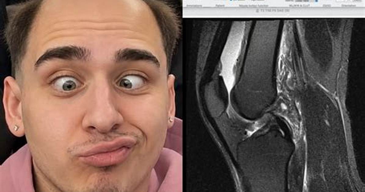 Lacy Knee Surgery Explained: Diagnosis, Stream Hiatus, and Expected Recovery Timeline