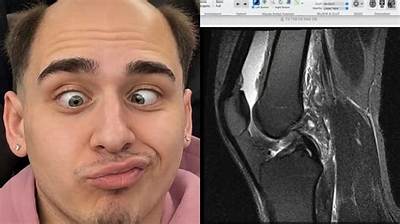 Lacy Knee Surgery Explained: Diagnosis, Stream Hiatus, and Expected Recovery Timeline