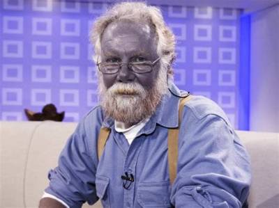 Real Humans Who Turned Blue: the Shocking True Medical Cases Behind the Line